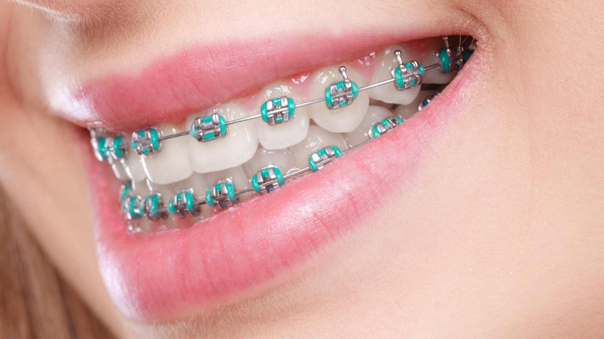 5 Tanda Gigi yang Harus Dipasang Behel Gigi