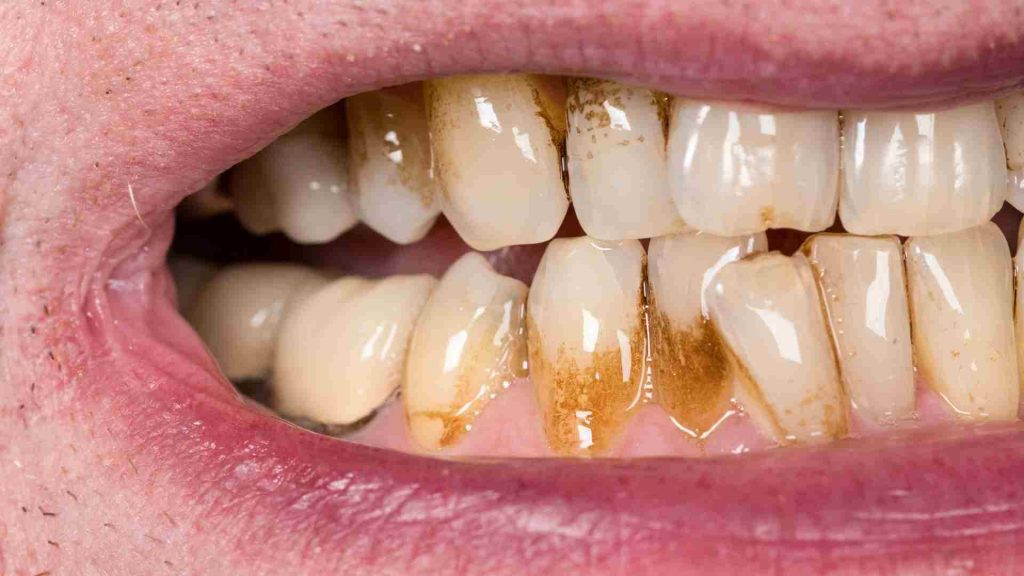5 Manfaat Kunyit untuk Kesehatan Gigi dan Mulut