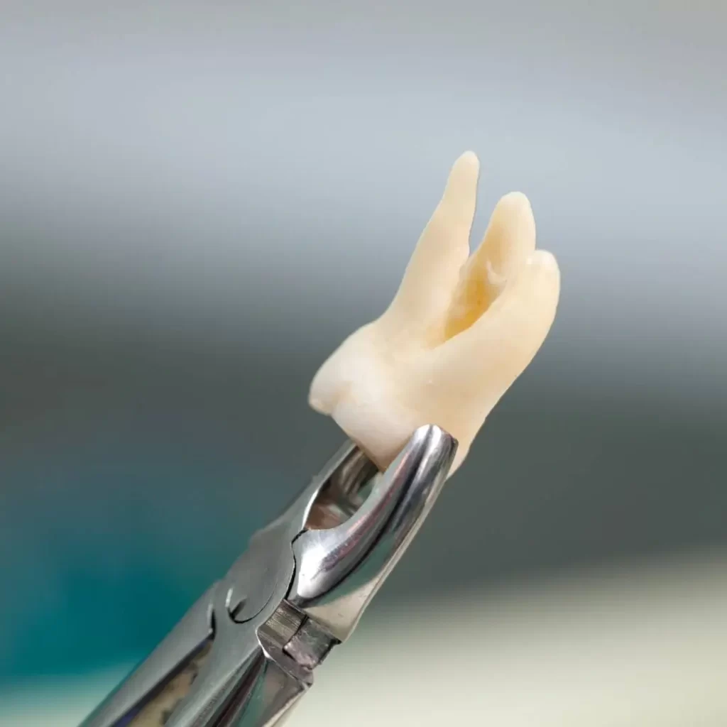 Kenapa gigi geraham bungsu terasa nyeri saat tumbuh?