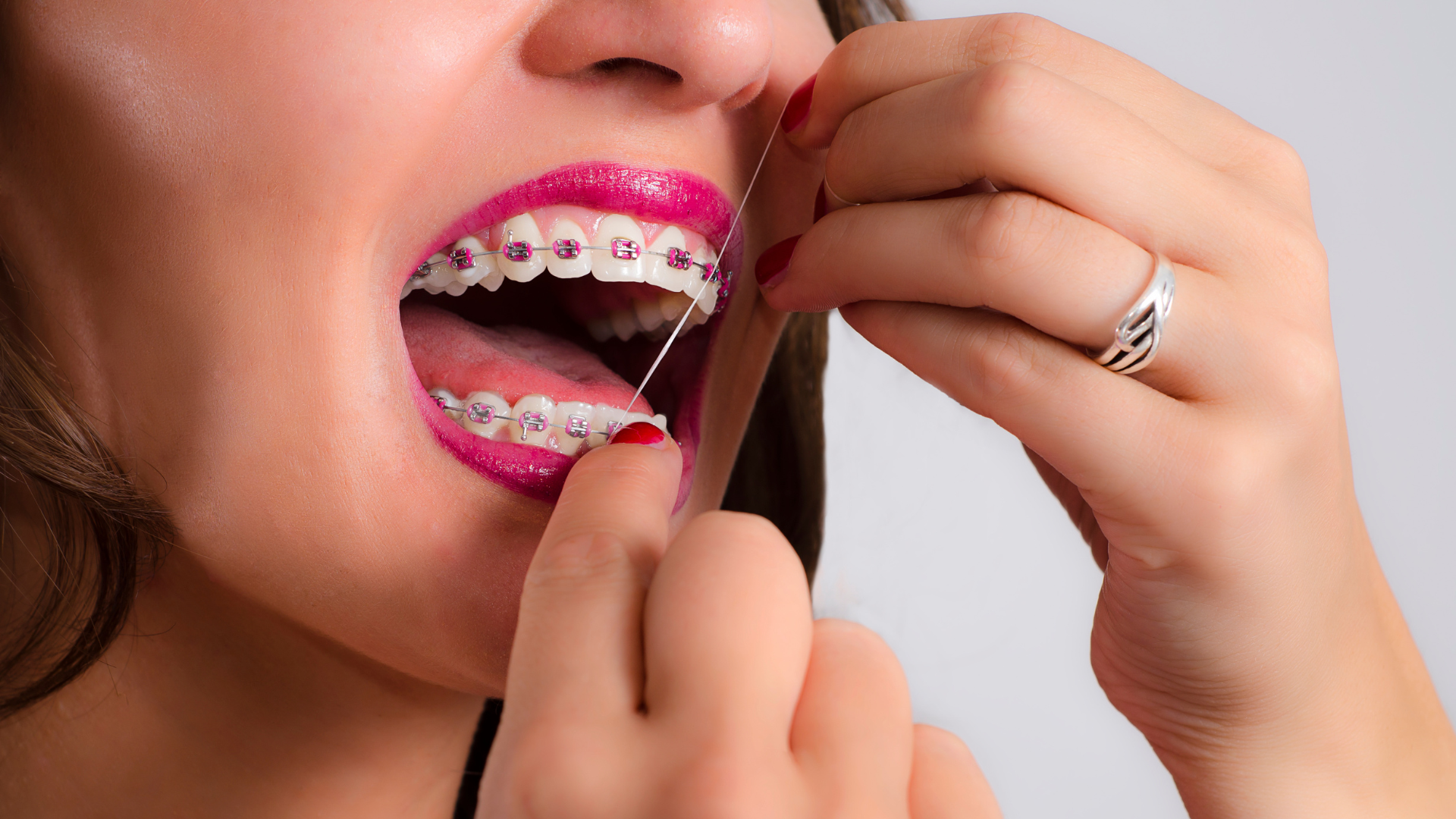 Kenali cara Flossing Gigi yang Tepat untuk Pengguna Behel