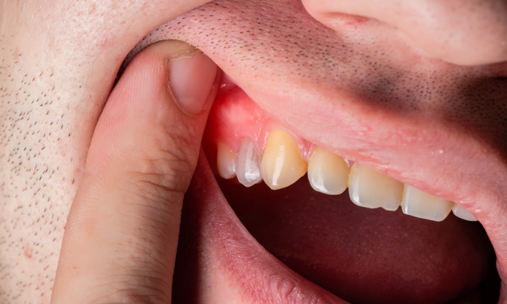 Ketahui Gejala dan Penyebab Abses Gigi yang Sering Diabaikan