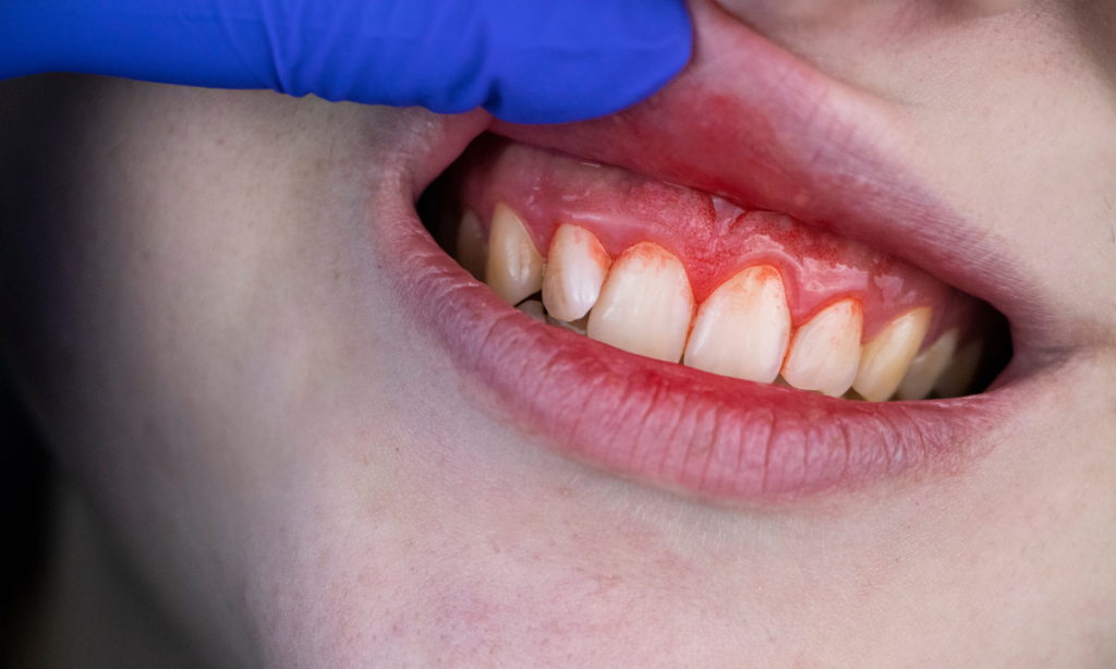 Mengapa Kita harus Menjaga Gigi dari Karang Gigi?