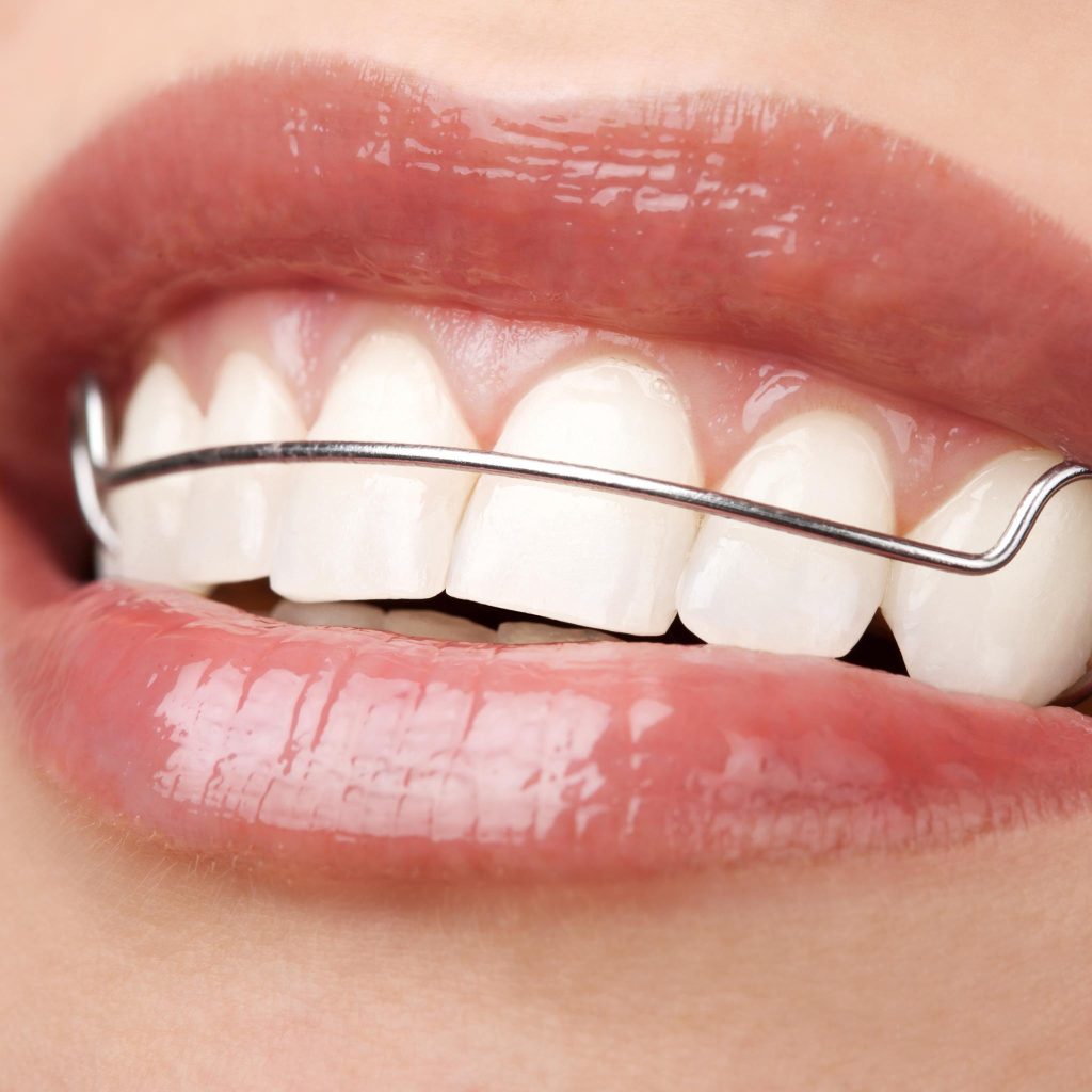 Dokter Gigi Spesialis Surabaya Ini Beda Aligner dan Retainer!