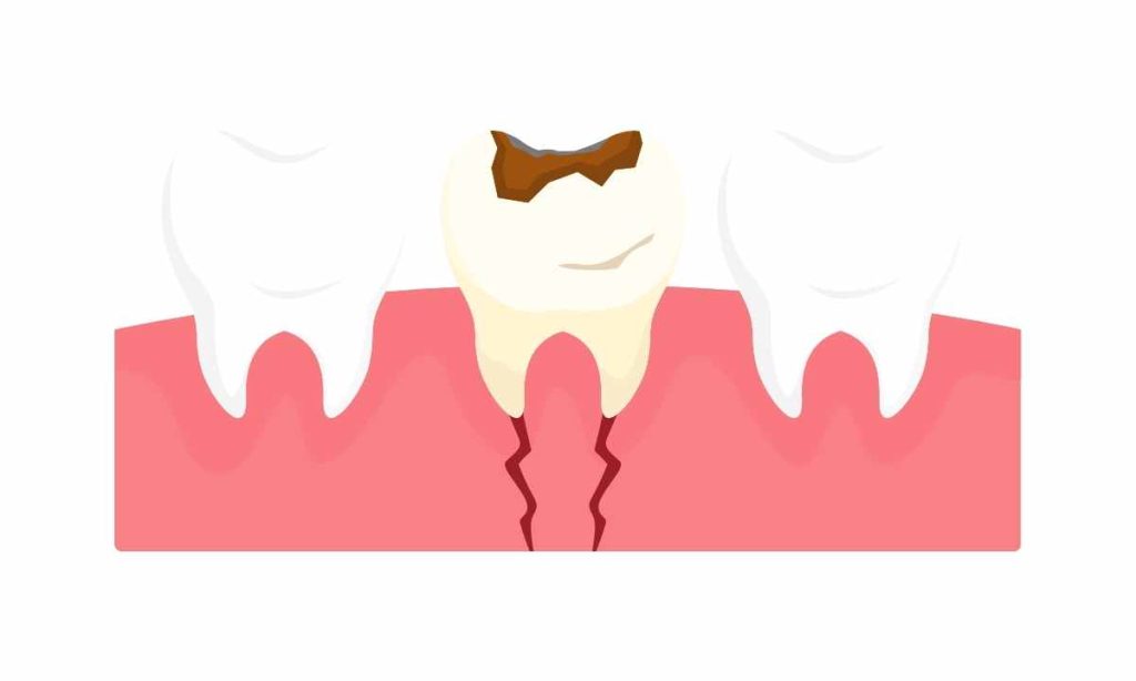 Ini dia Masalah Gusi Akibat Kurangnya Perawatan Gigi