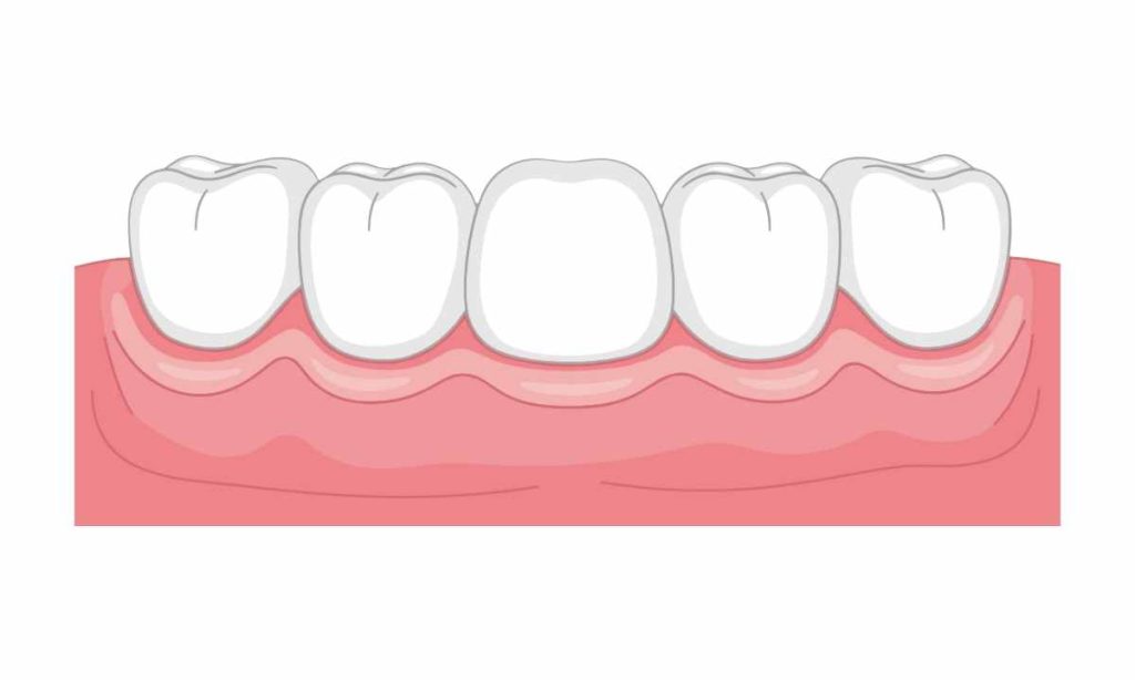 Ini dia Masalah Gusi Akibat Kurangnya Perawatan Gigi