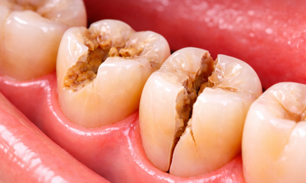 Jenis-Jenis Retakan, Patahan, dan Tingkat Keparahan pada Gigi