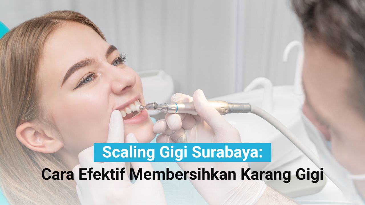 Scaling Gigi Surabaya: Cara Efektif Membersihkan Karang Gigi
