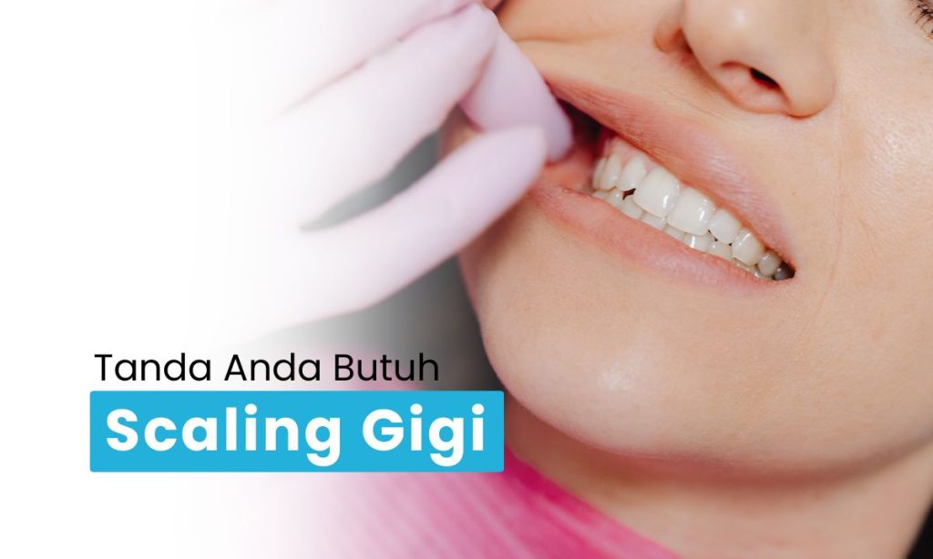 Scaling Gigi Surabaya: Cara Efektif Membersihkan Karang Gigi